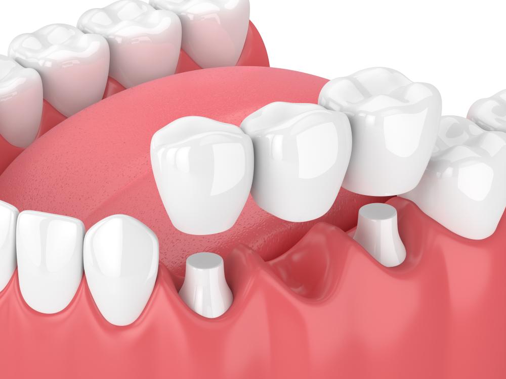 dental implant