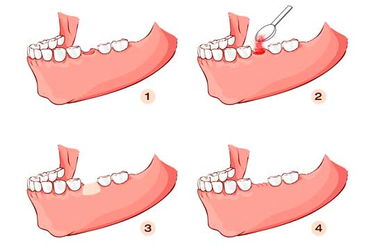 Implants Dentist in Lithia Springs