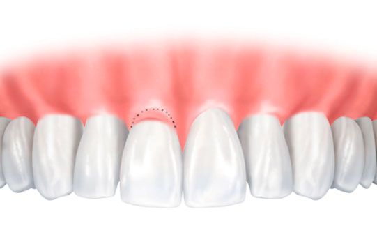 Implants Dentist in Lithia Springs