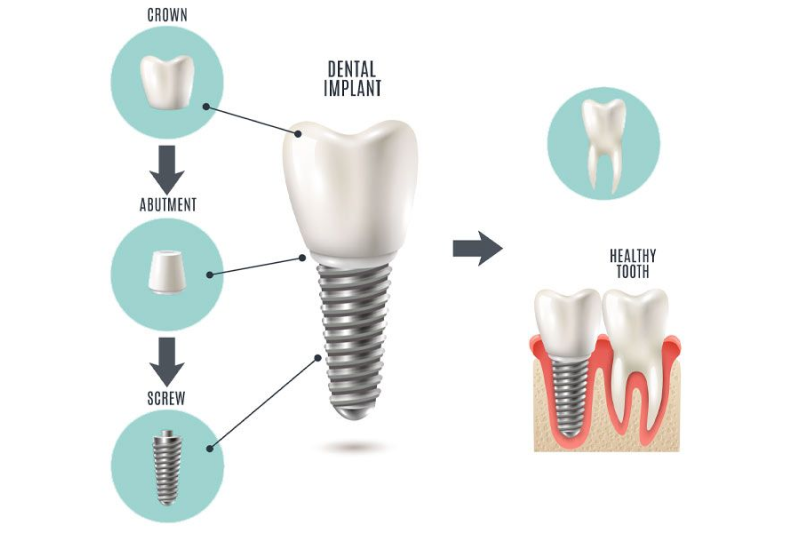 Implants Dentist in Lithia Springs