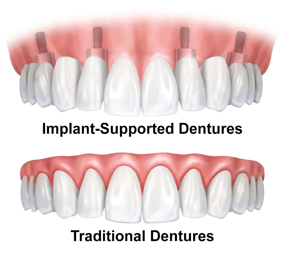 Implants Dentist in Lithia Springs