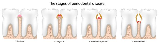 Implants Dentist in Lithia Springs