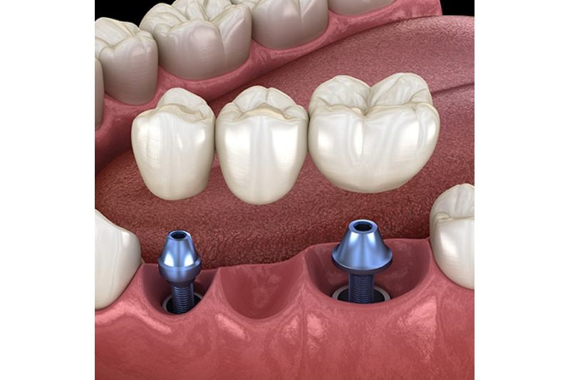 Implants Dentist in Lithia Springs