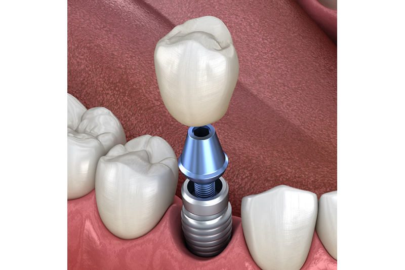 Implants Dentist in Lithia Springs