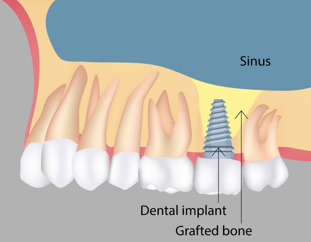 Sinus Lift in Lithia Springs